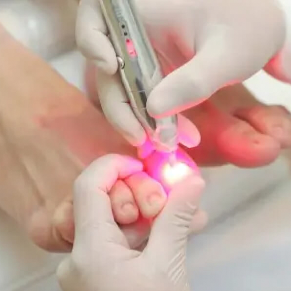 Sem Título-1 Laser Podológico - Image 1